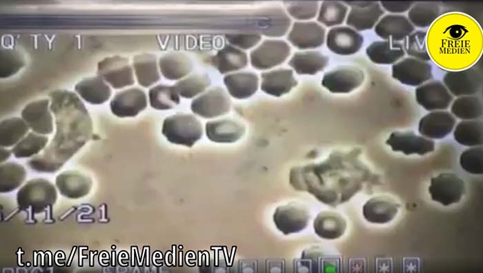 Blutzellen nach einer mRNA Covid Impfung unter dem Mikroskop